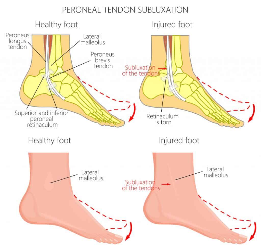Picture of Peronal Tendon Subluxation