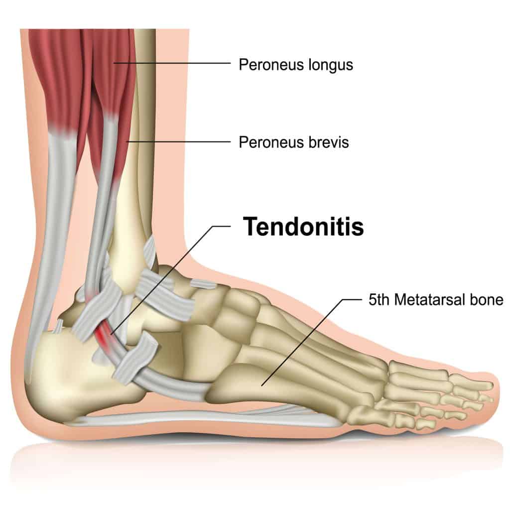 Picture diagram of Peroneal Tendonitis