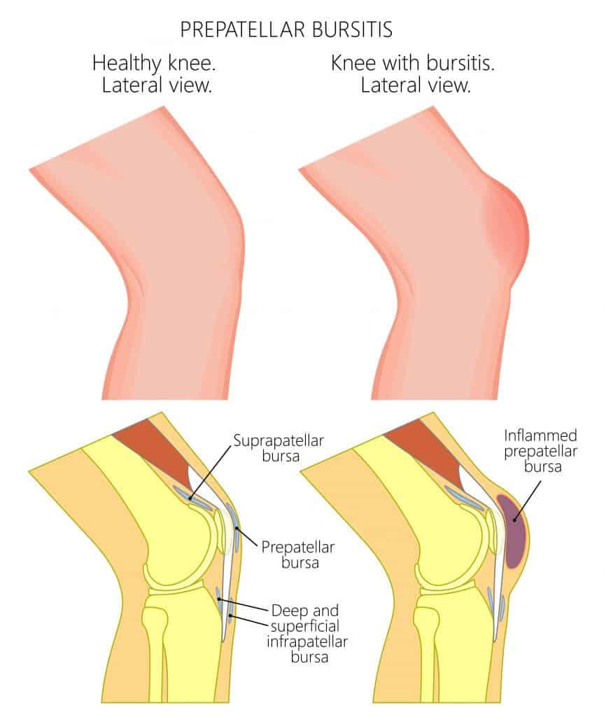 housemaids-knee-prepatellar-bursitis-explained-by-a-knee-expert