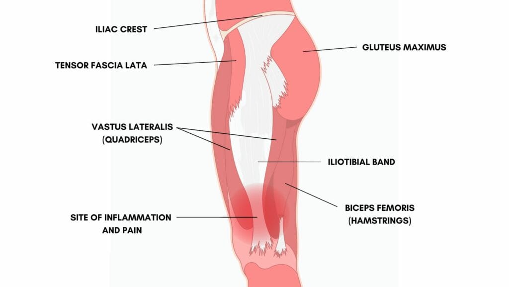 Diagram of the anatomy of the Iliotibial band