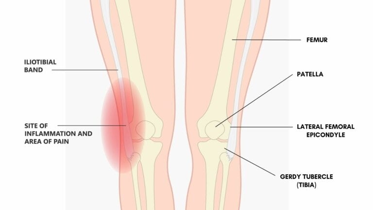 Iliotibial Band Syndrome | Symptoms, Diagnosis and Causes