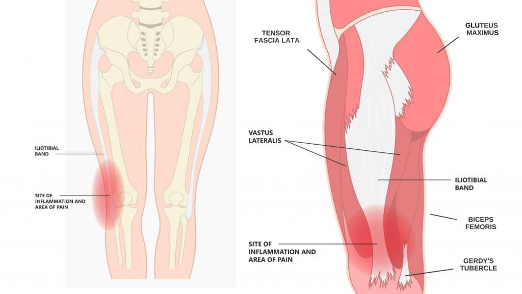 Diagram of iliotibial band syndrome