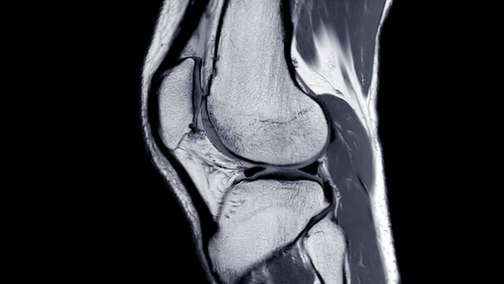 chondromalacia-patella-chondrosis-of-the-knee