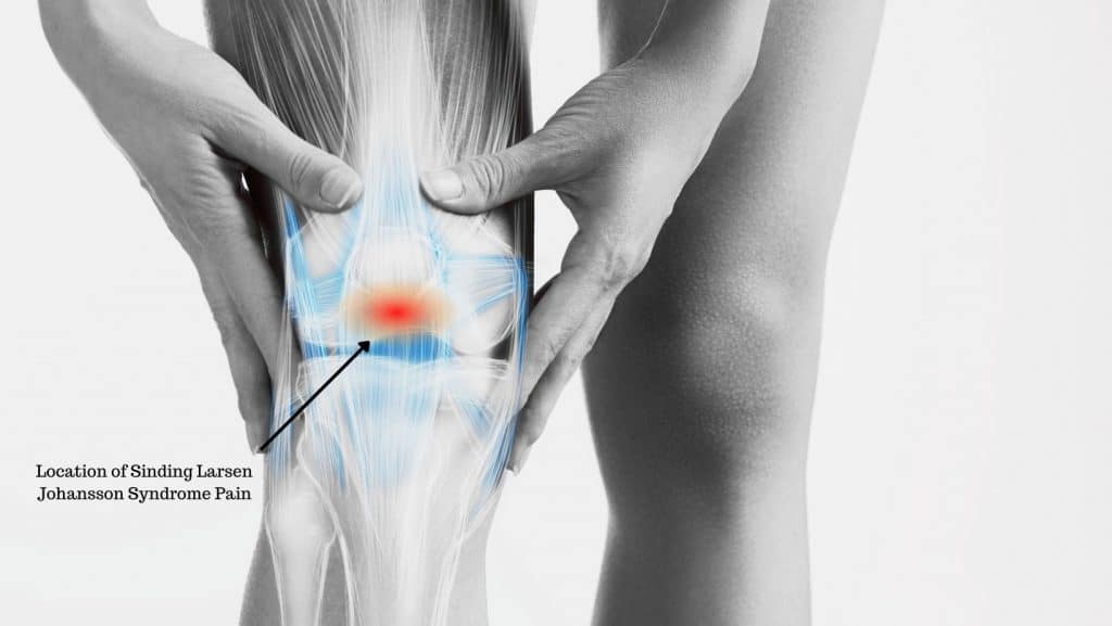 Picture of Location of Sinding Larsen Johansson Syndrome Pain