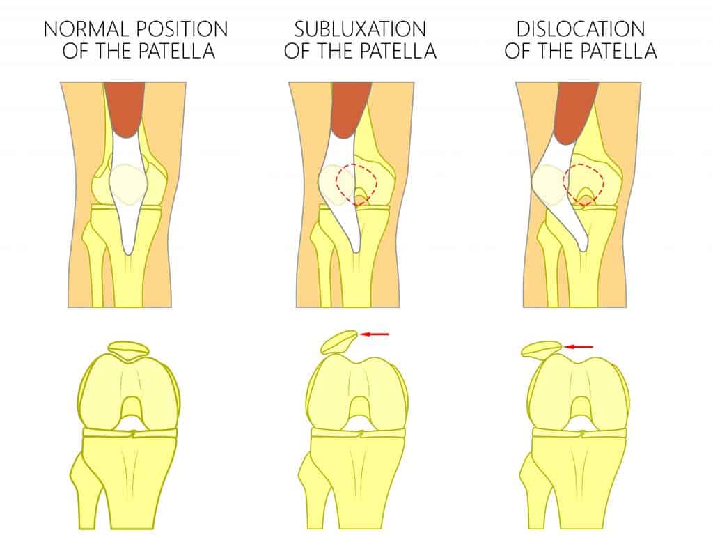 Picture diagram of Patellar Subluxation and dislocation