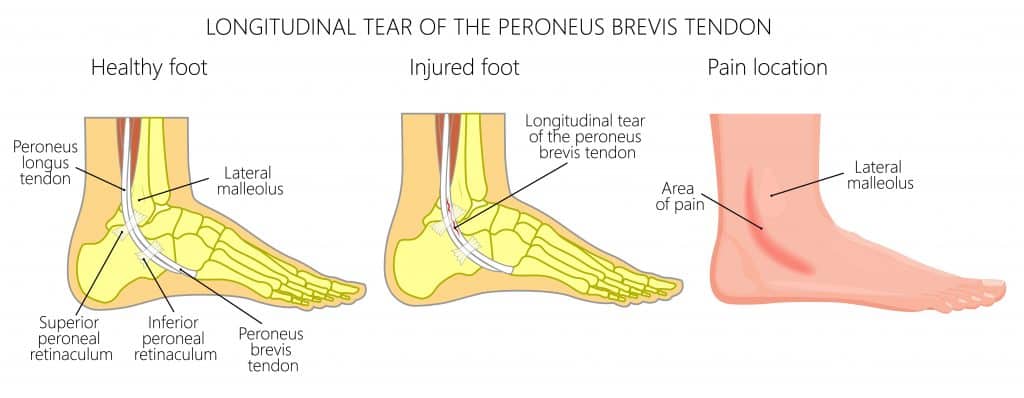 Picture diagram of Peroneal Tendon Longitudinal Tear