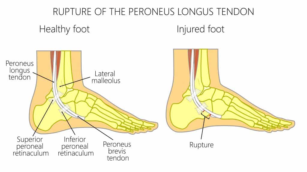 Picture diagram of a Peroneal Tendon Rupture