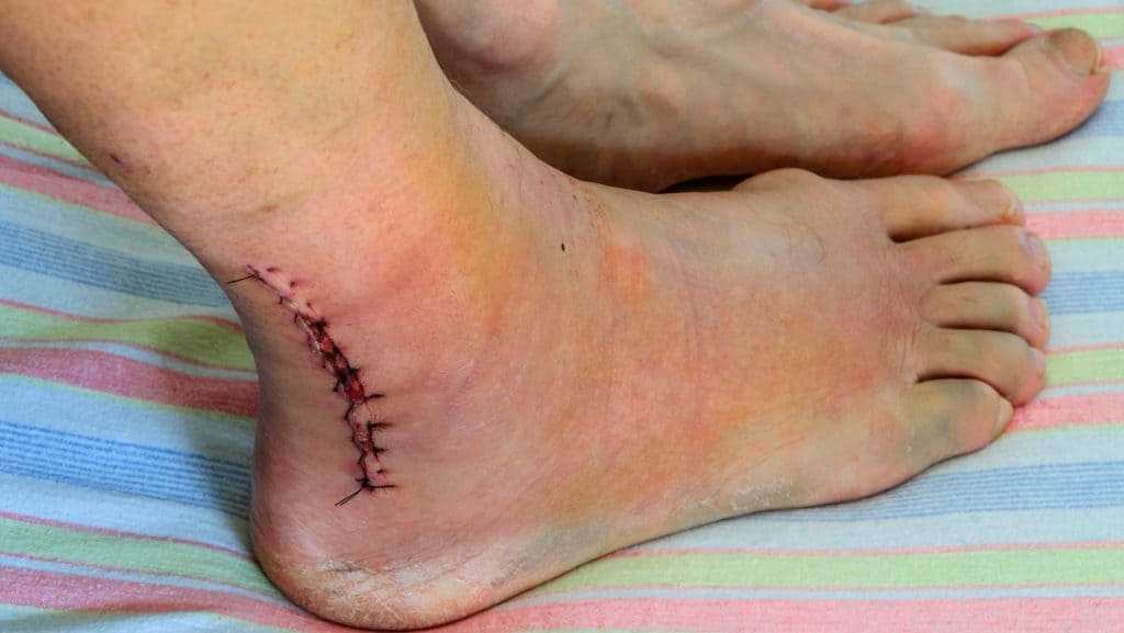 Picture of an ankle after surgery