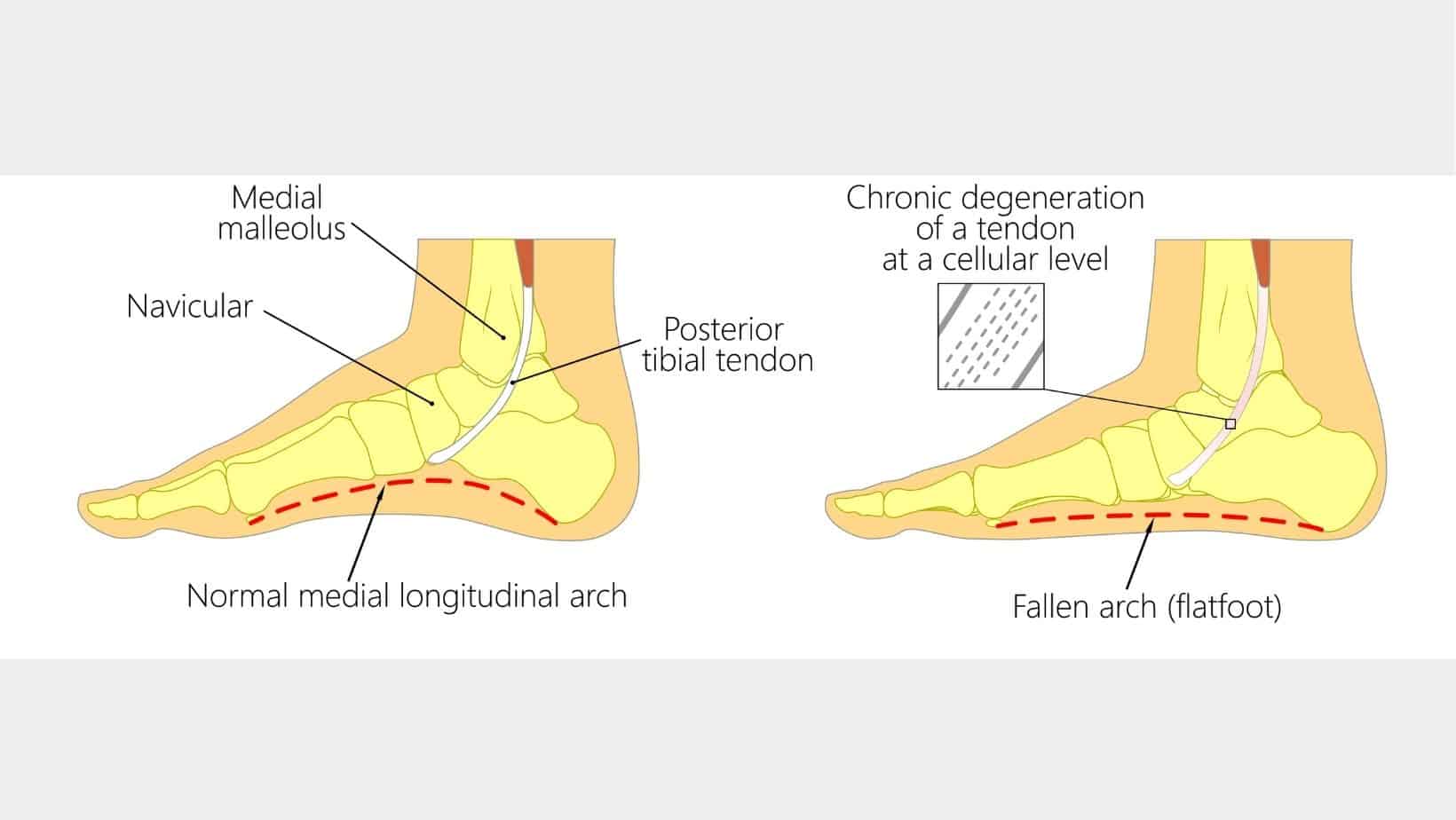 posterior tibial tendon diagram