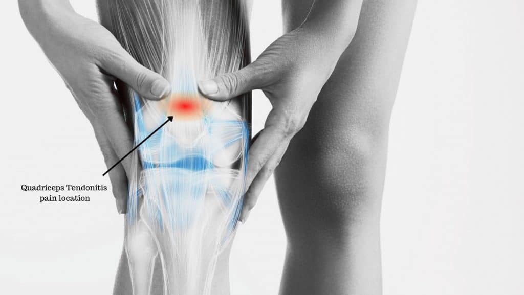 Diagram showing Quadriceps Tendonitis pain location