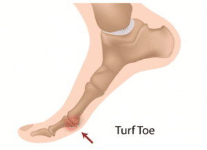 Turf Toe Anatomy, Symptoms & Treatment | Turf Toe Taping