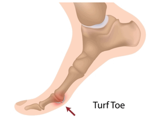 Turf Toe Diagram
