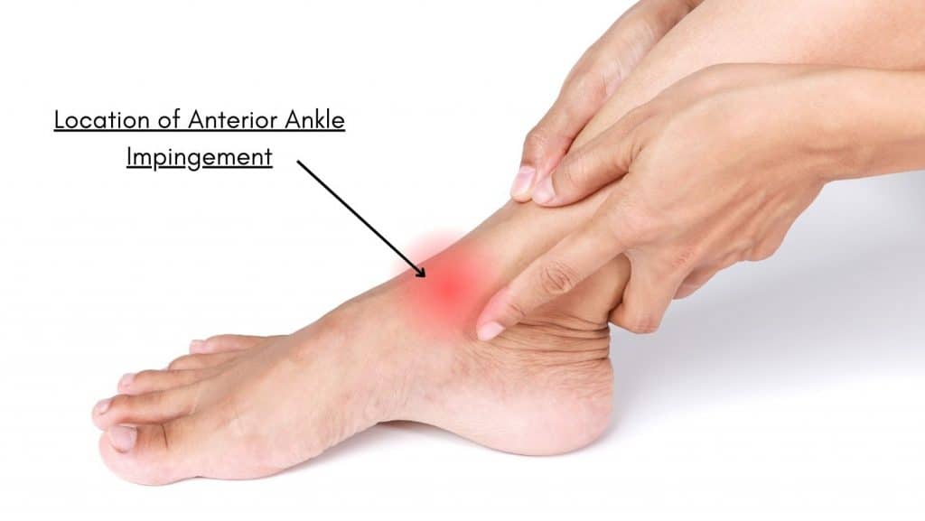 Picture of Anterior Ankle Impingement Location of Pain