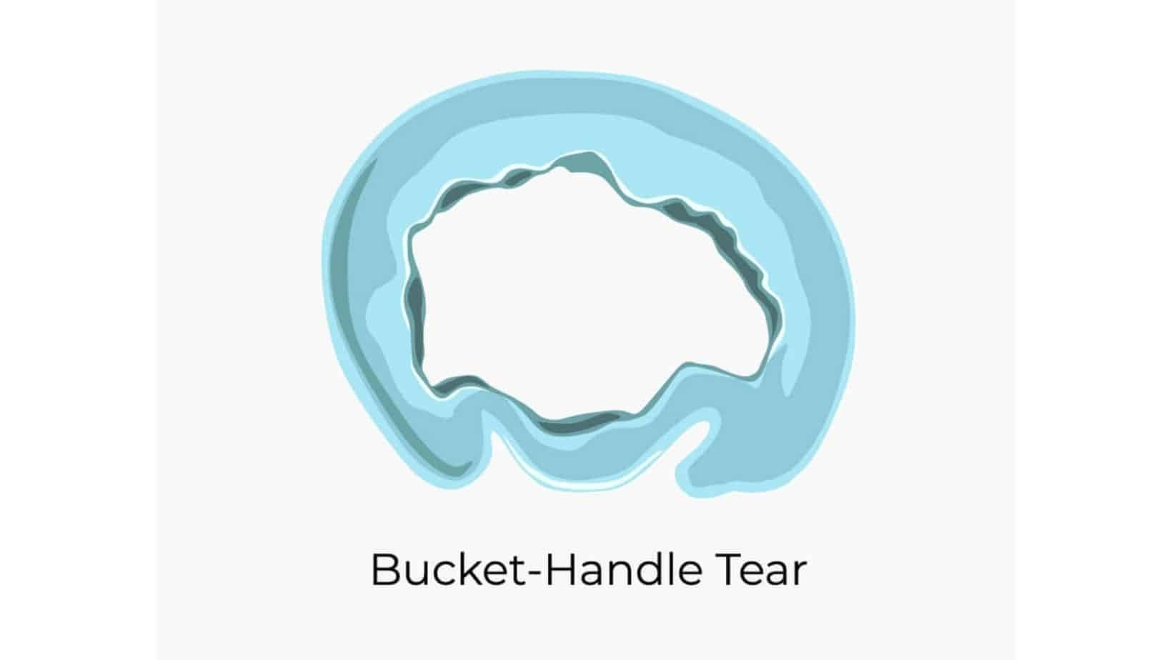 Bucket Handle Meniscus Tear and Other Common Meniscus Tears