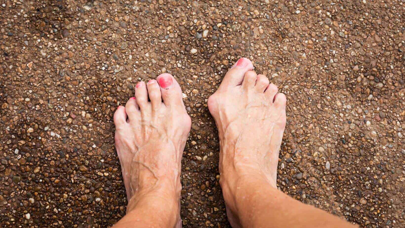 Corn Vs Bunion | Bunion Vs Callus | Gout Vs Bunion