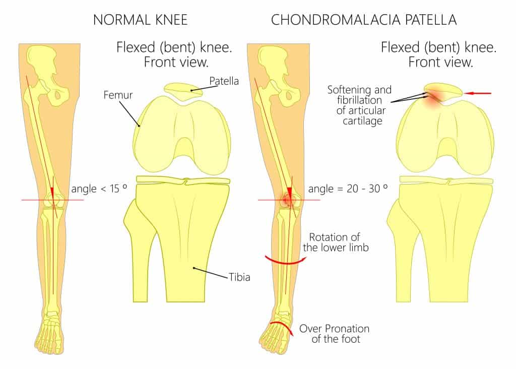 Diagram of chondromalacia patella
