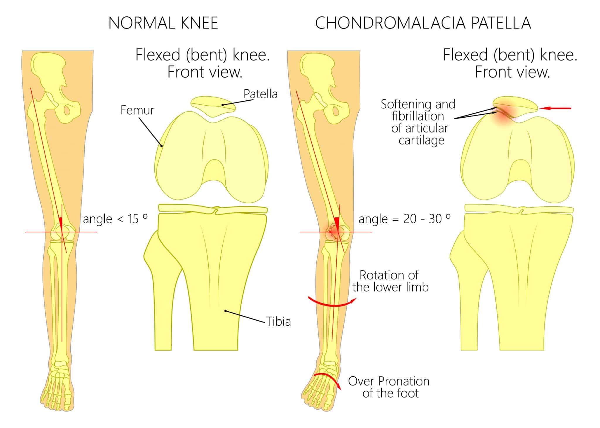 Chondromalacia Patella Chondrosis Of The Knee