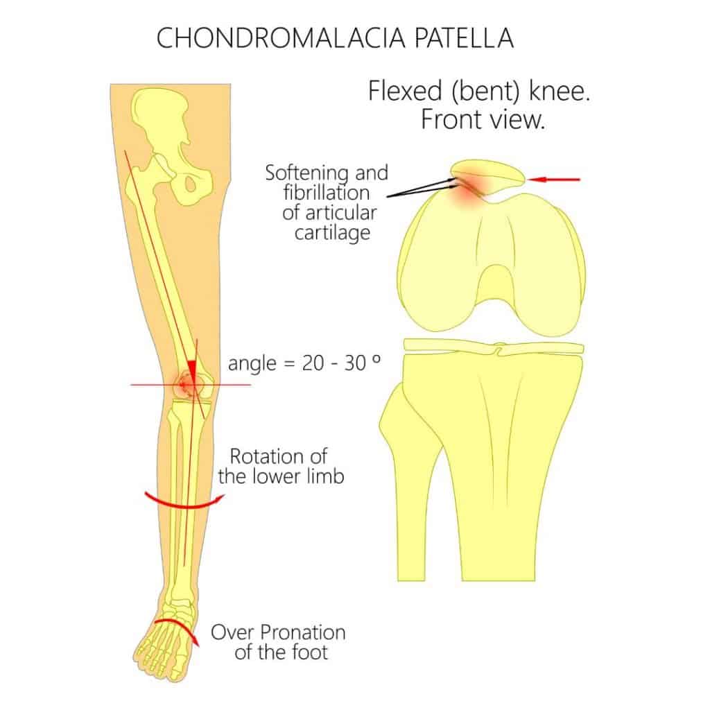 Image of Chondromalacia Patella diagram