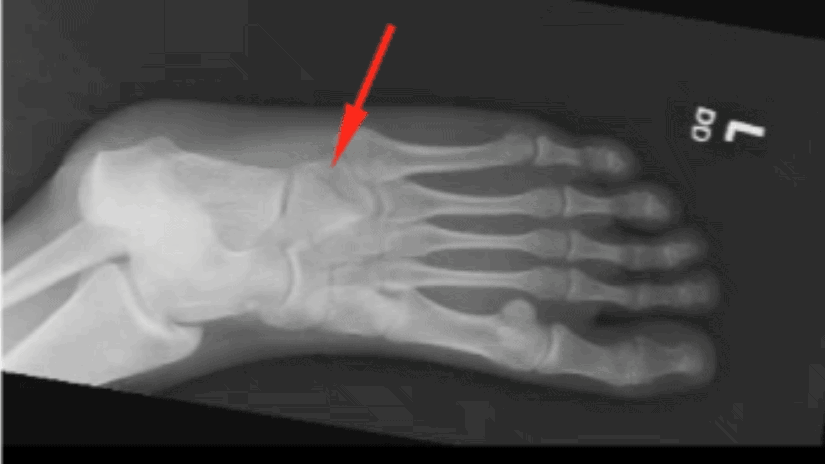 cuboid fracture healing