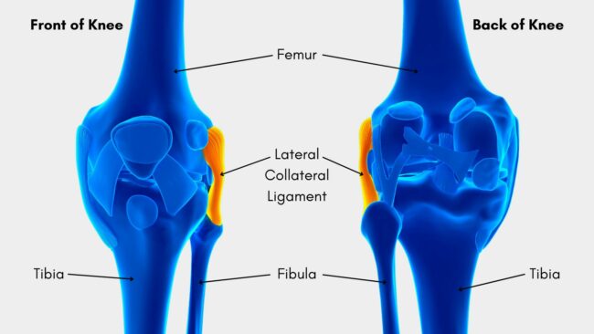 Diagram of the LCL, the lateral collateral ligament of the knee
