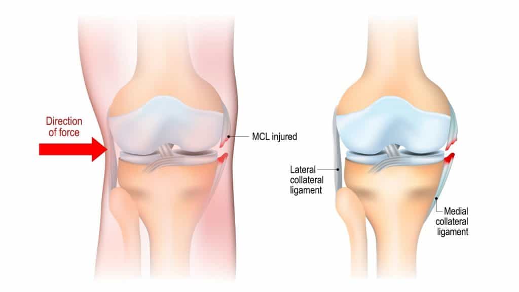 Diagram of medial collateral ligament injury