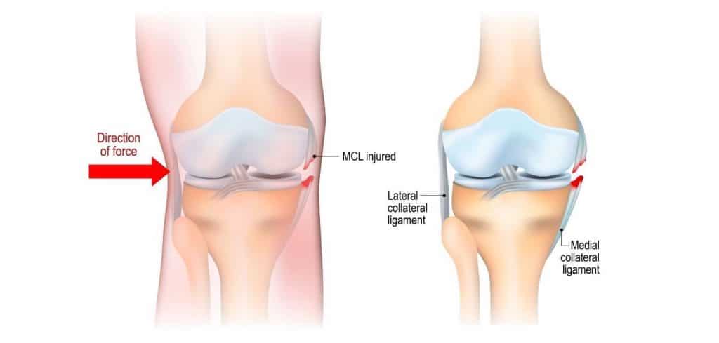 sprained-mcl-recovery-time-for-grade-1-2-and-3-injuries