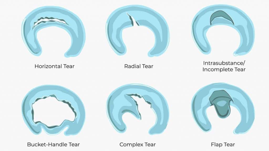 Diagram of different meniscus tear types