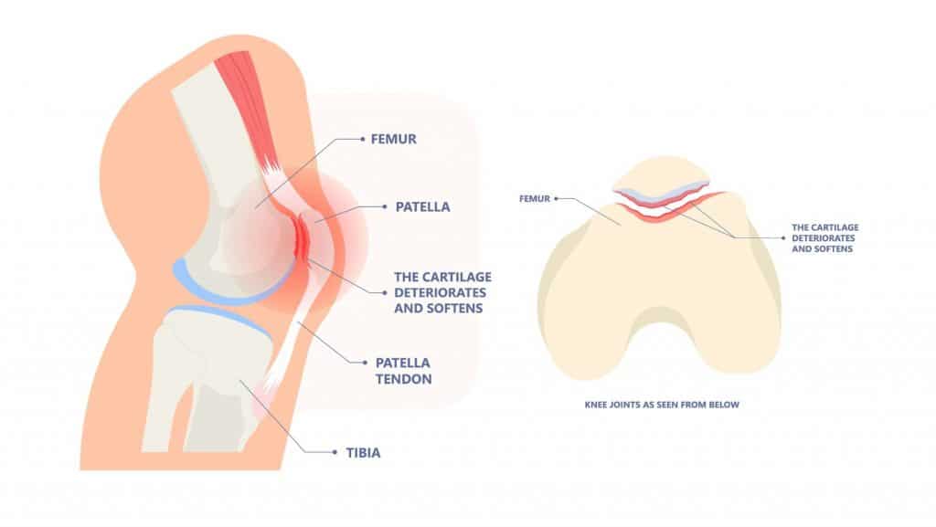 Diagram of patellofemoral pain syndrome runners knee