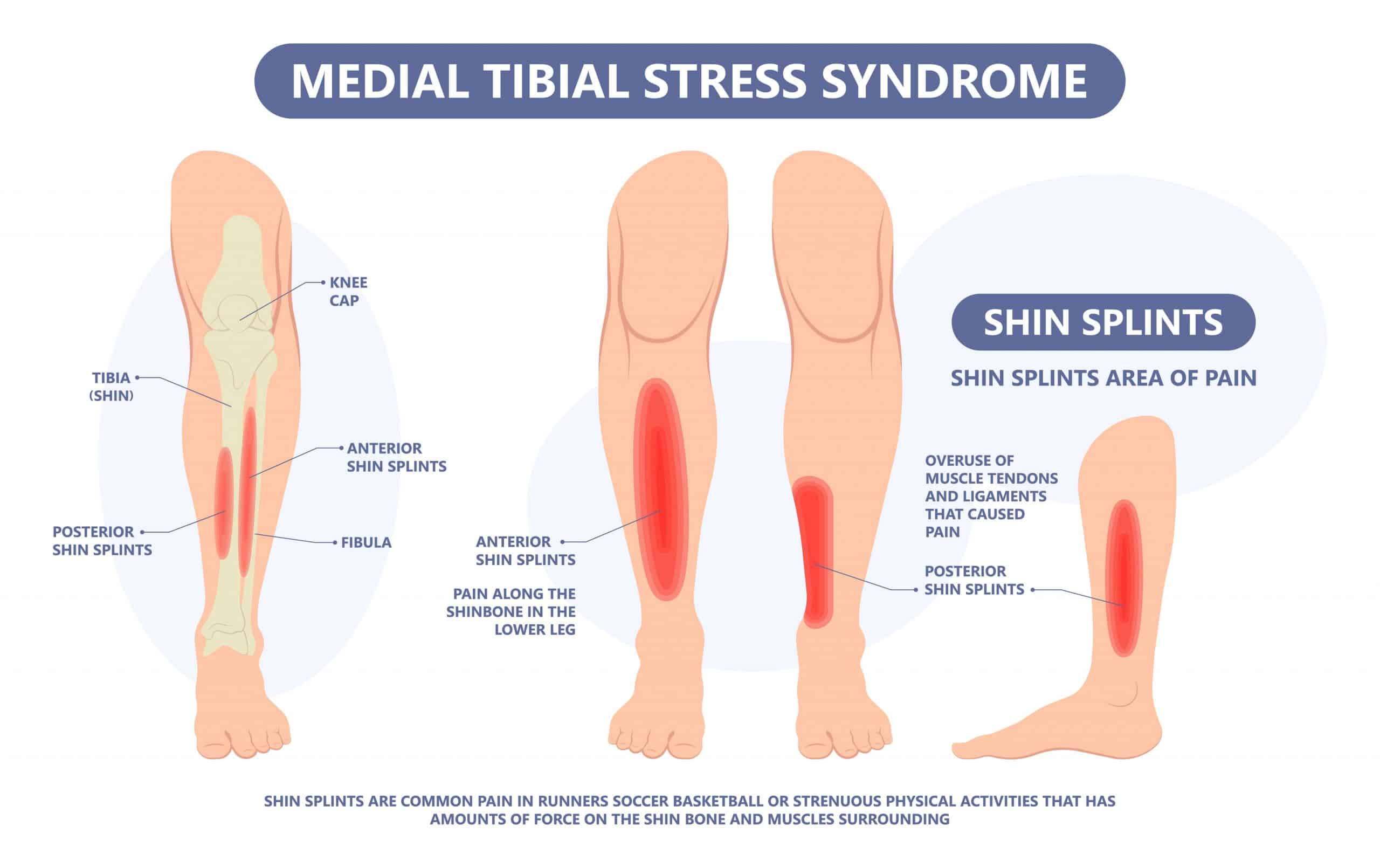 Shin Splints: What are they and What are the symptoms? - James
