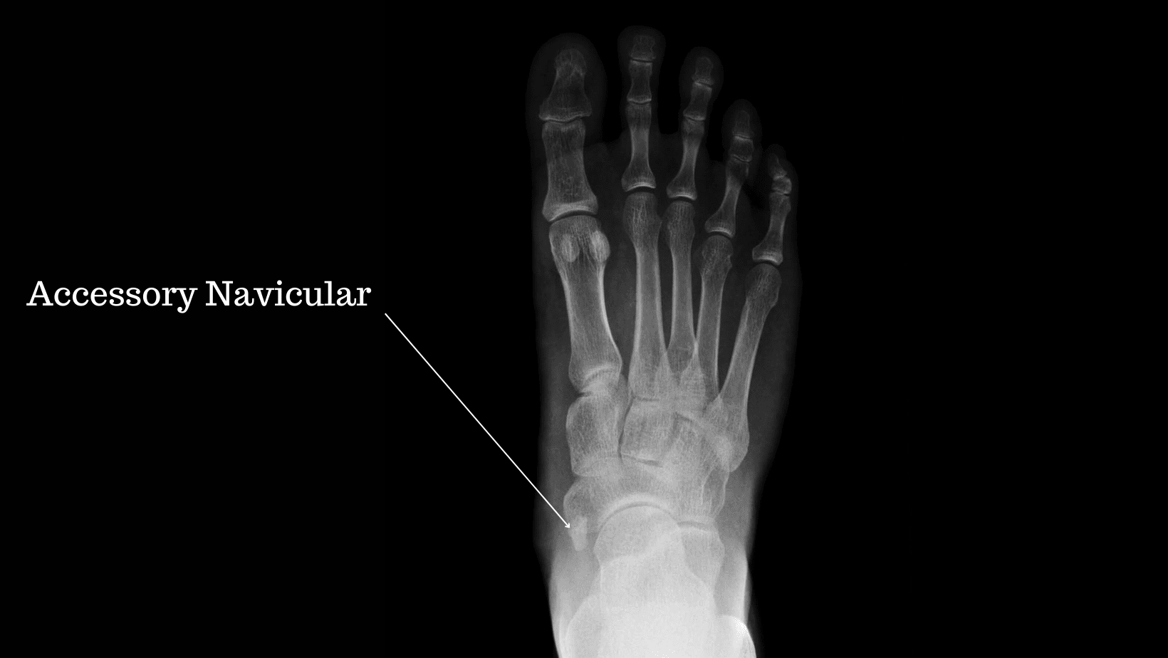 Accessory Bones Foot X Ray at Elida Anderson blog