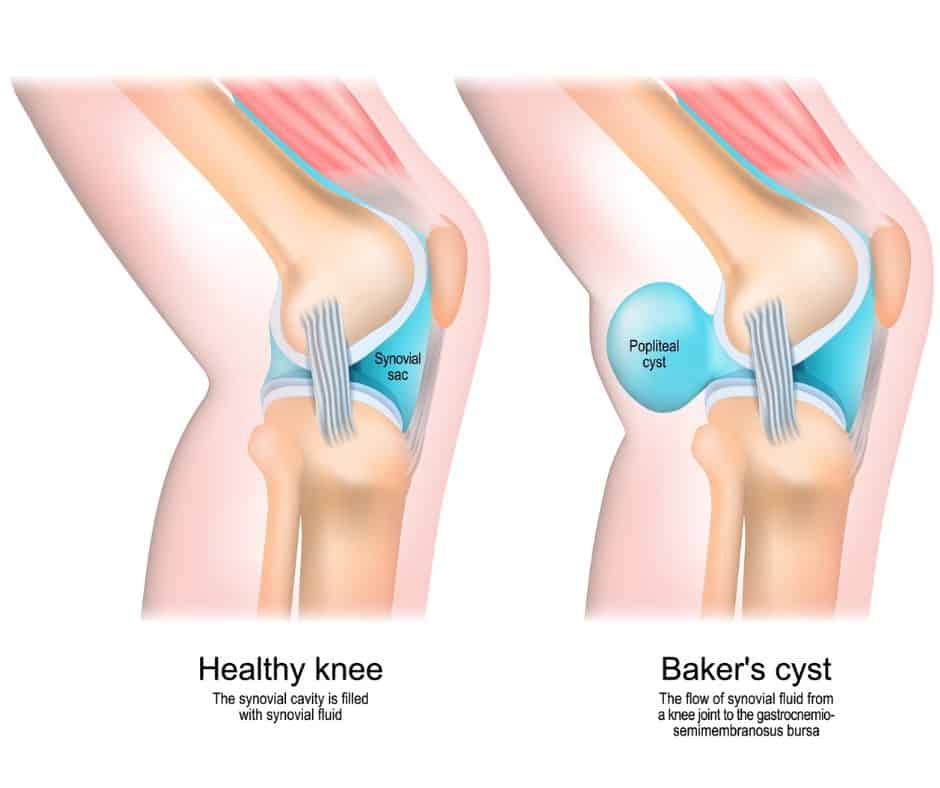 Diagram of Baker's Cyst