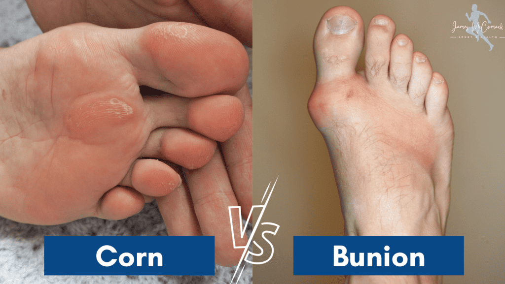 Picture of a Corn vs Bunion