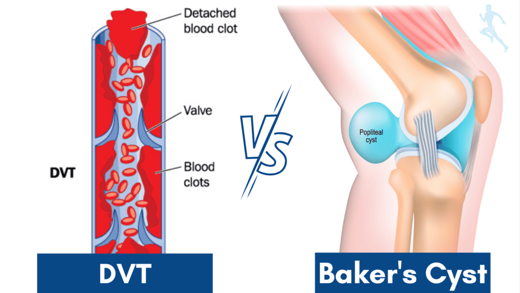 Picture of DVT vs Baker's Cyst Diagram