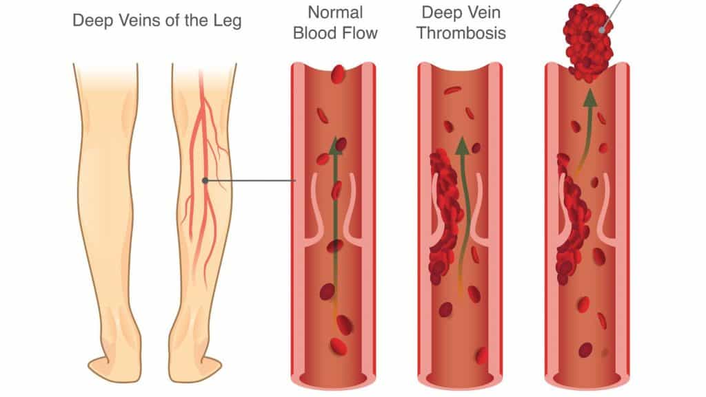 Diagram of deep vein thrombosis