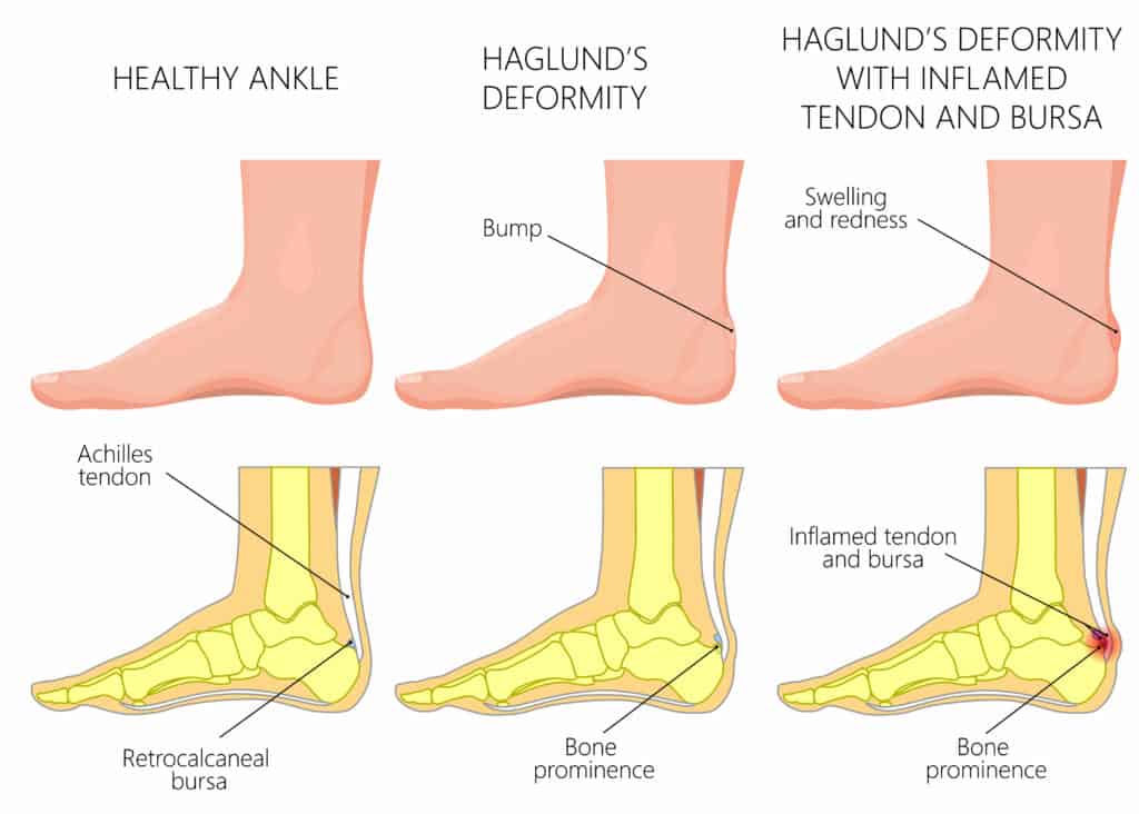 Haglund's Deformity diagram