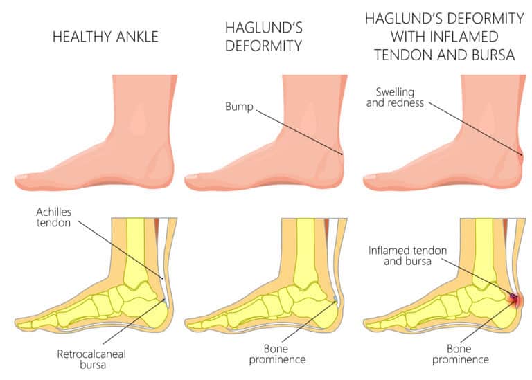 Haglund’s Deformity - James McCormack