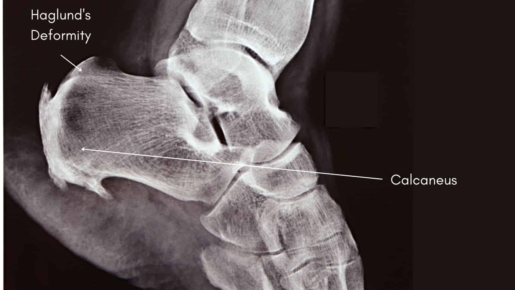 Retrocalcaneal Bursitis Explained by a Physical Therapist