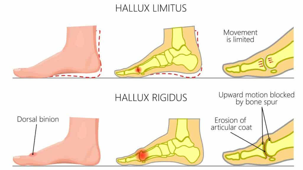 Hallux Limitus vs Hallux rigidus Diagram