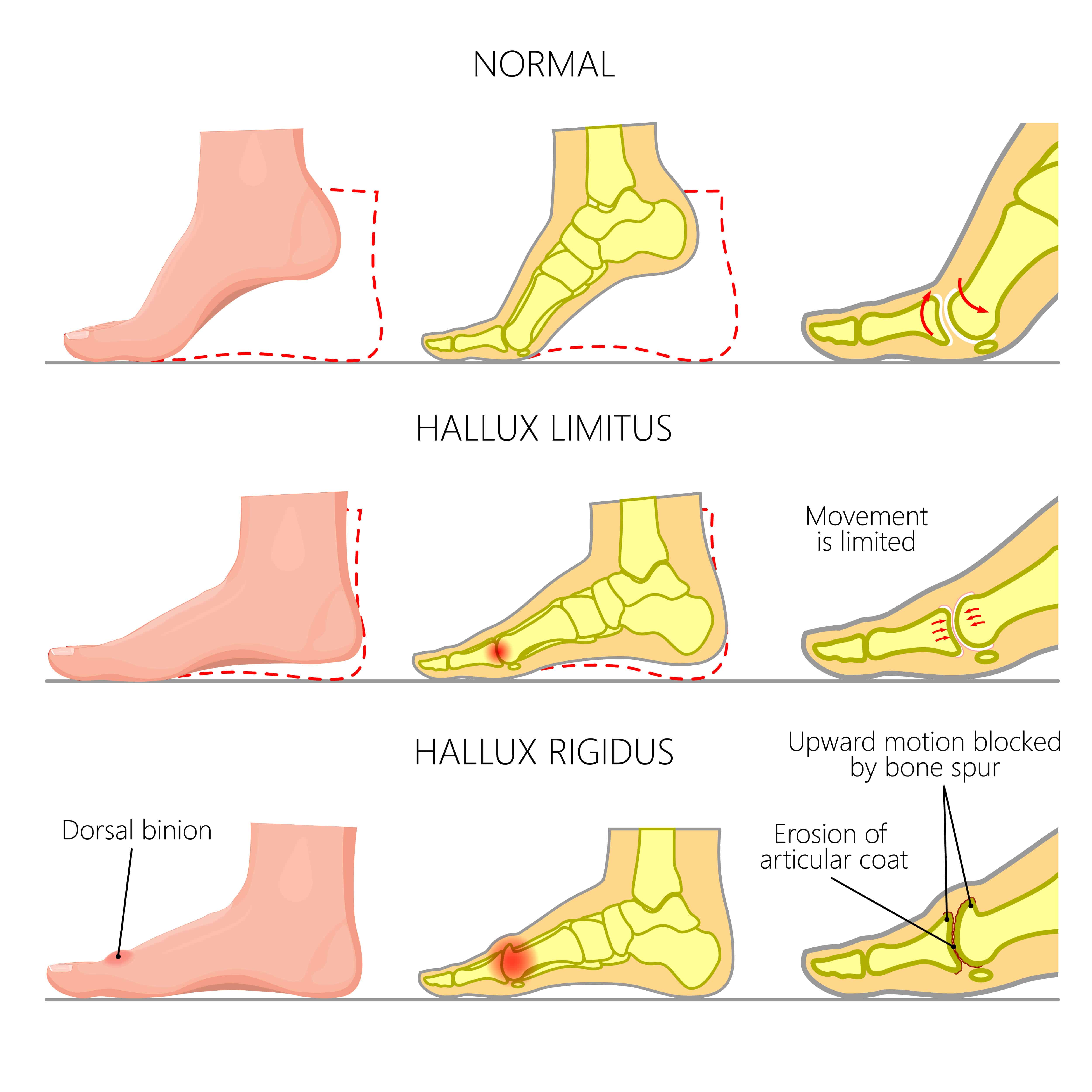 Hammer Toe vs. Bunion