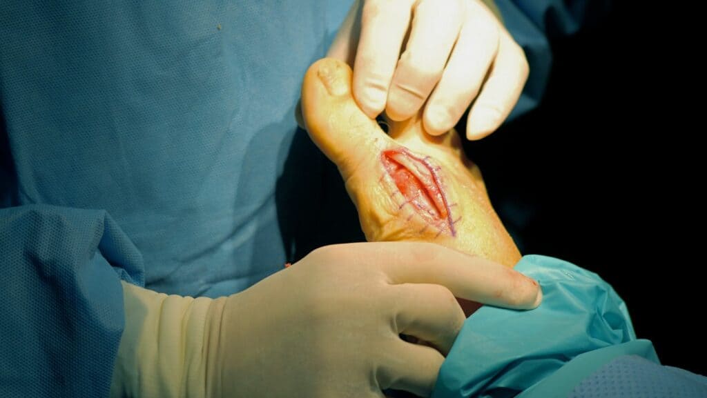 Picture of Hallux Rigidus Surgery