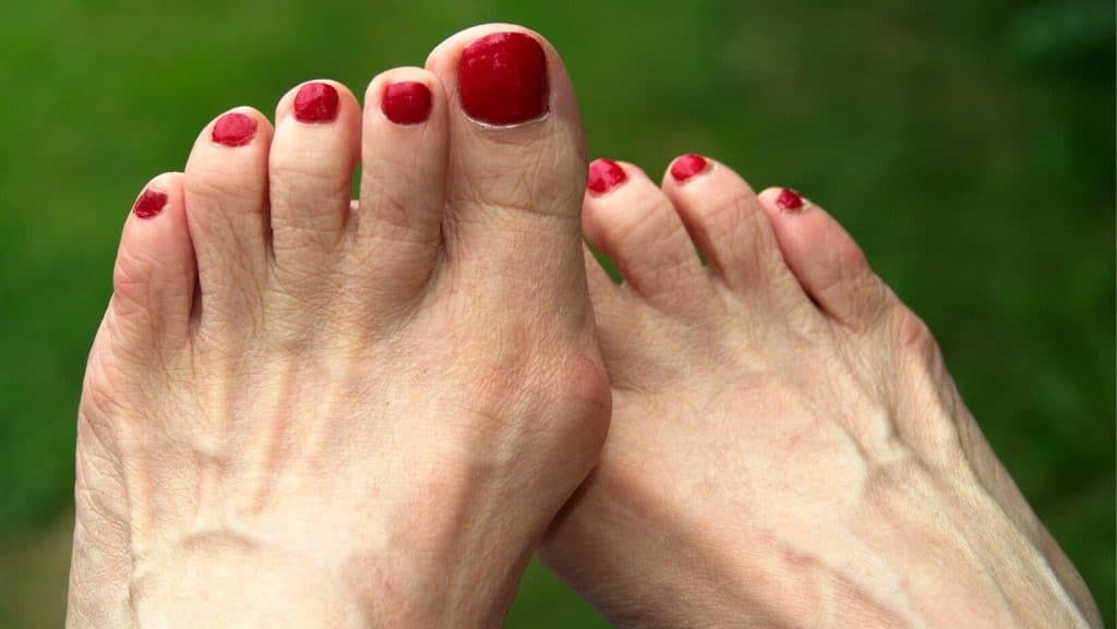 Are Bunions Hereditary? Get the answers from a Bunion Specialist