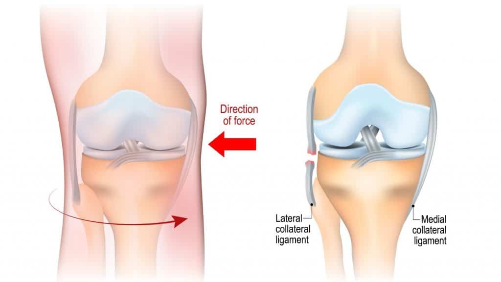 Diagram of LCL Injury