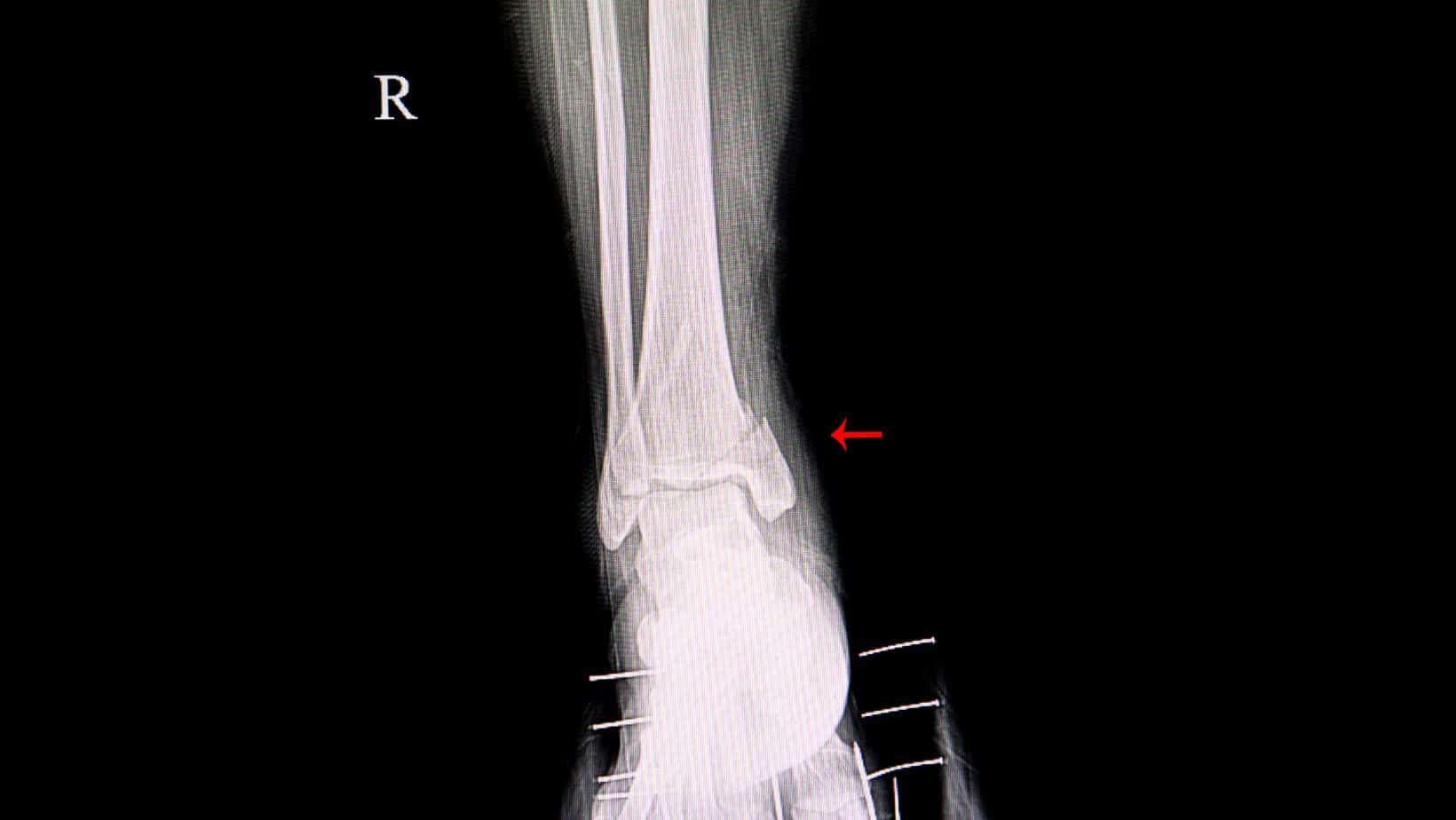 medial malleolus