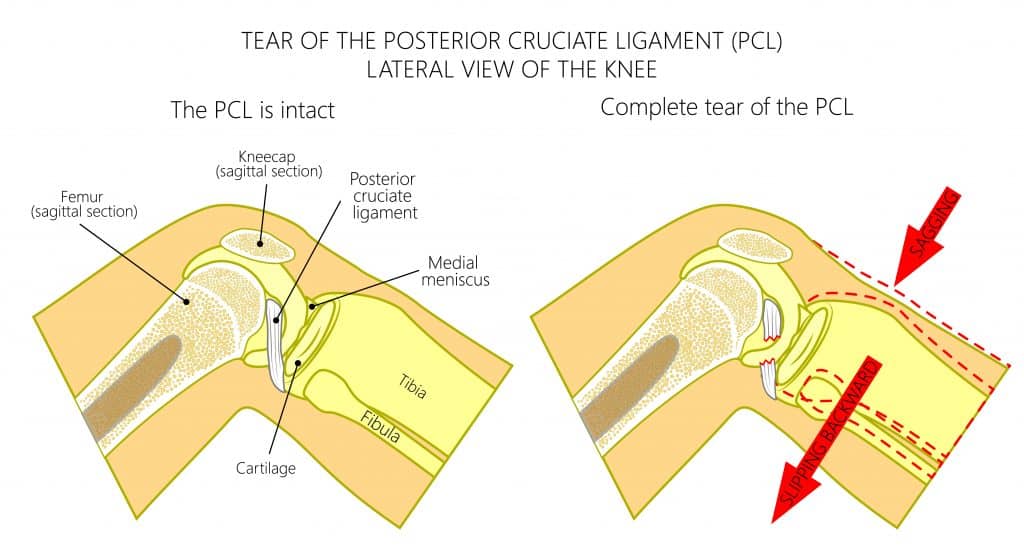 Diagram of PCL