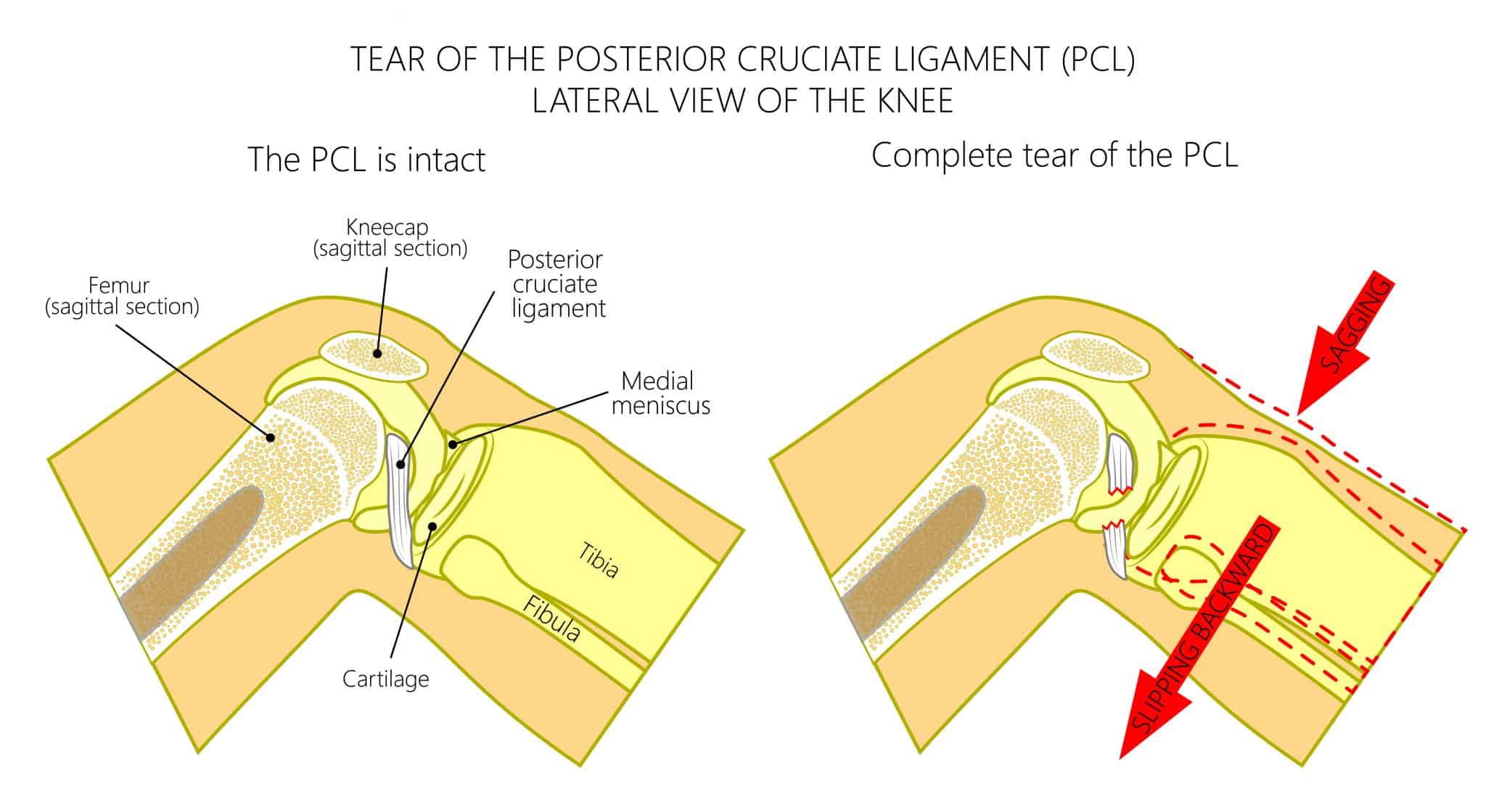 PCL Tear Frequently Asked Questions