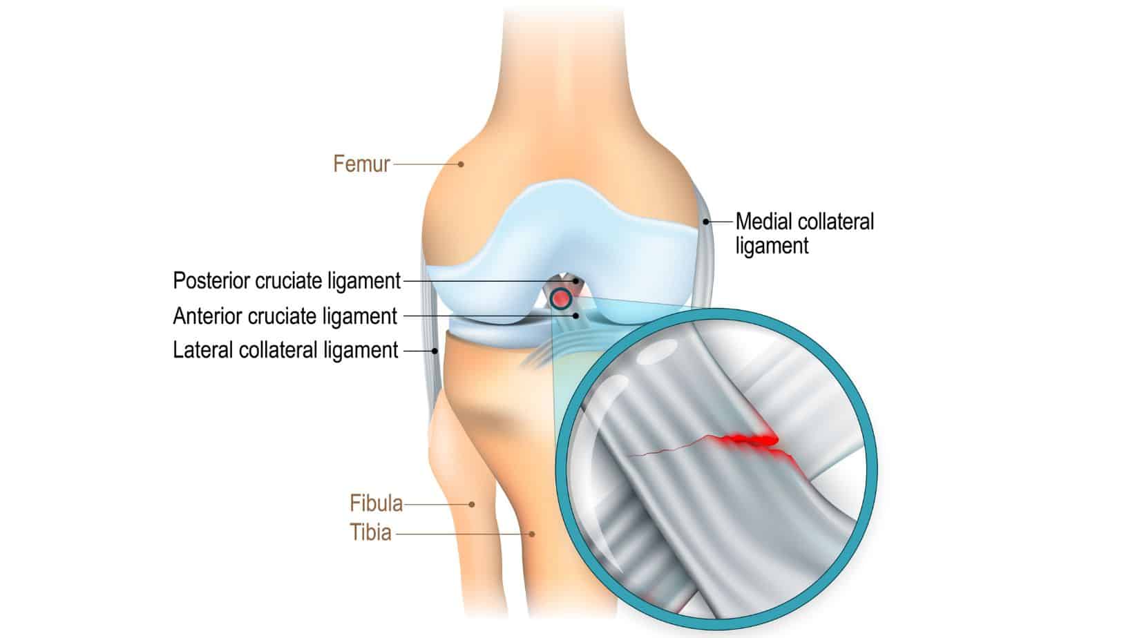 acl-sprain-faqs-anterior-cruciate-ligament-sprain-faqs