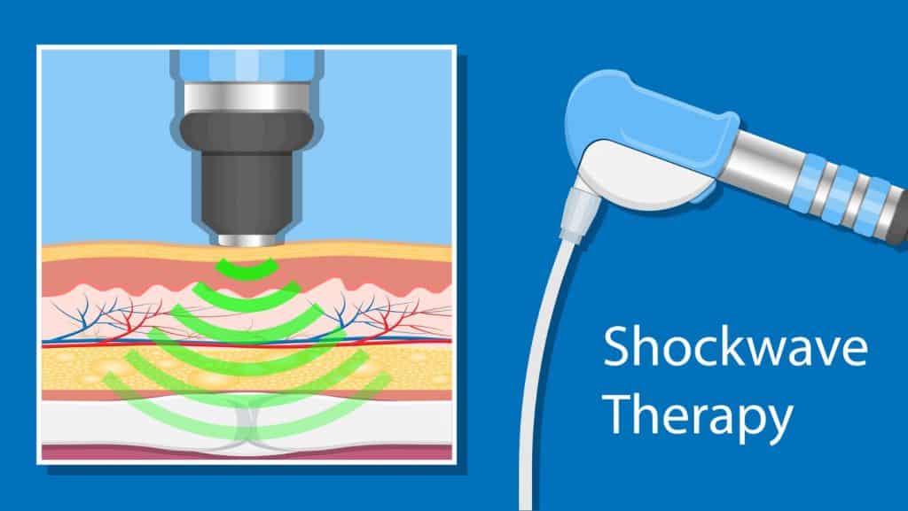Diagram of shockwave therapy