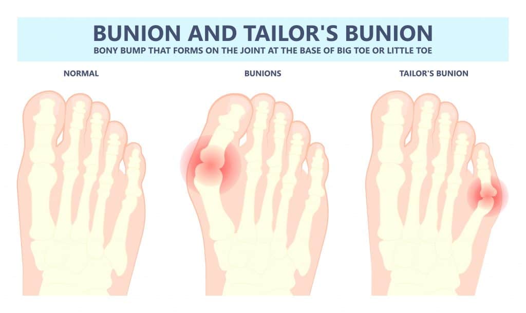 Tailor's Bunion Diagram
