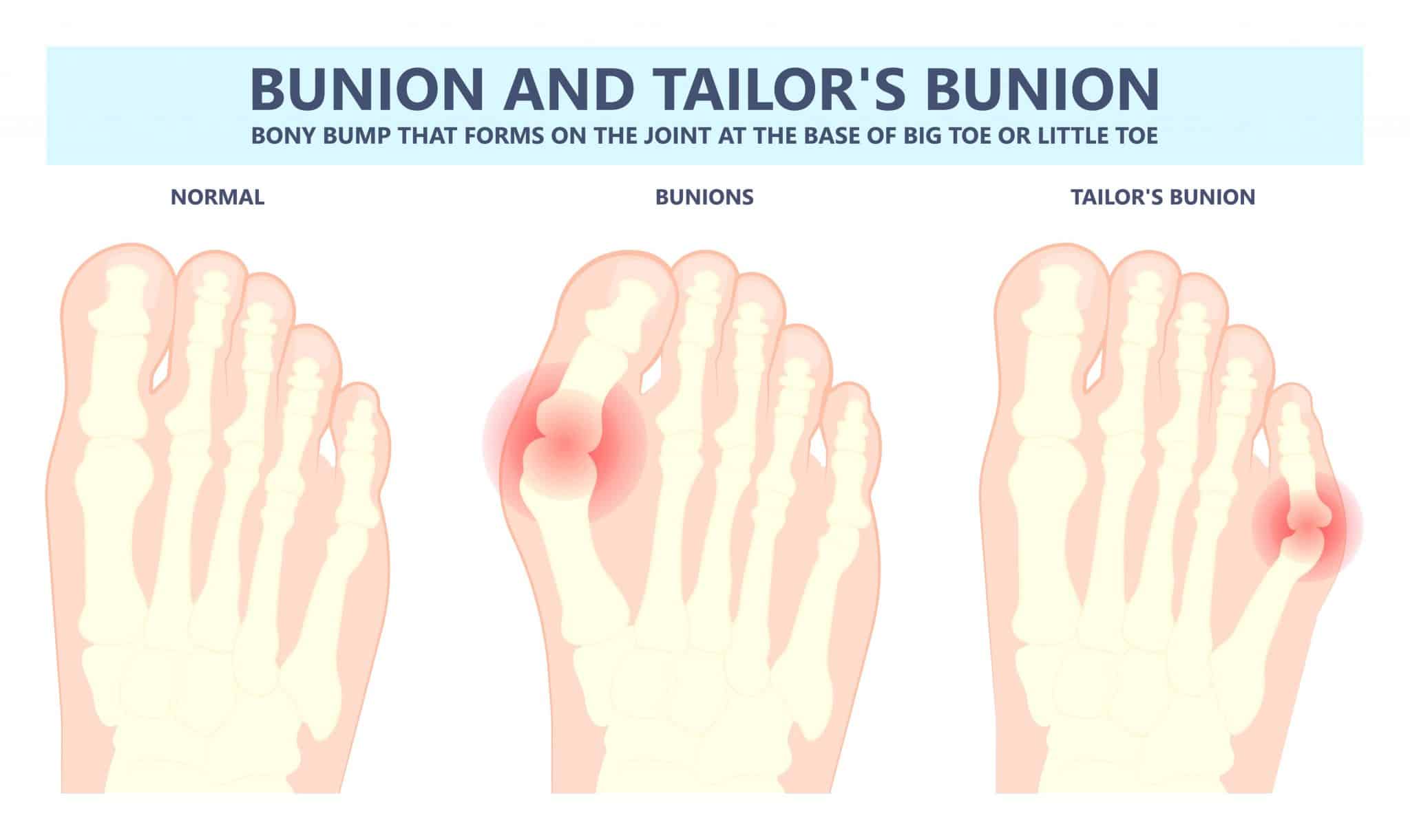 Tailor S Bunion How To Treat A Tailor S Bunion Pinky Toe Bunion