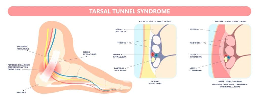Tarsal Tunnel Syndrome Diagram